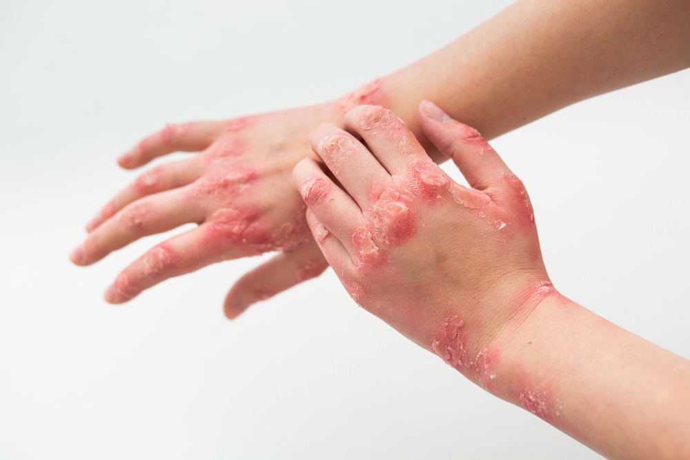 Ayurvedic treatment for skin problems Sharjah